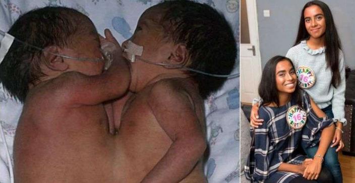 Despite facing near-impossible odds, separated Siamese twins have defied expectations and blossomed into beautiful individuals as they grew up.